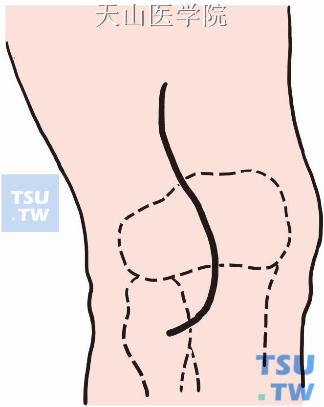于腘窝正中线做“S”形切口，长8～10cm
