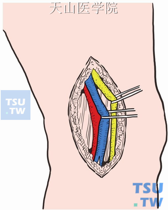 找出并游离胫神经，用橡皮带向一侧牵开，显露腘静脉远侧段，并向远侧游离，必要时切开腓肠肌内、外侧头间的筋膜，至胫前静脉和胫腓干静脉，均以橡皮带牵开