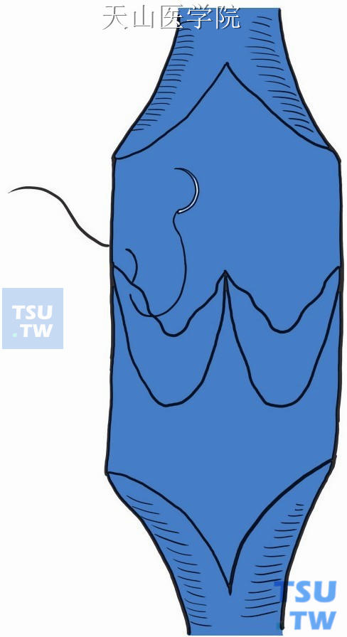 再于游离缘距其止点1mm处缝一针