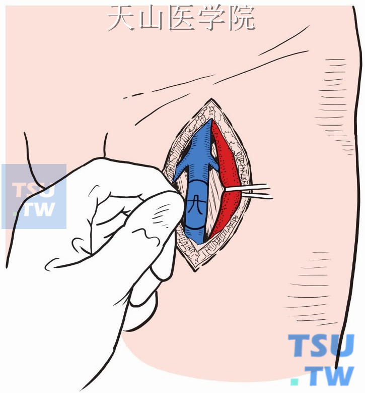 股浅静脉瓣膜包窄术