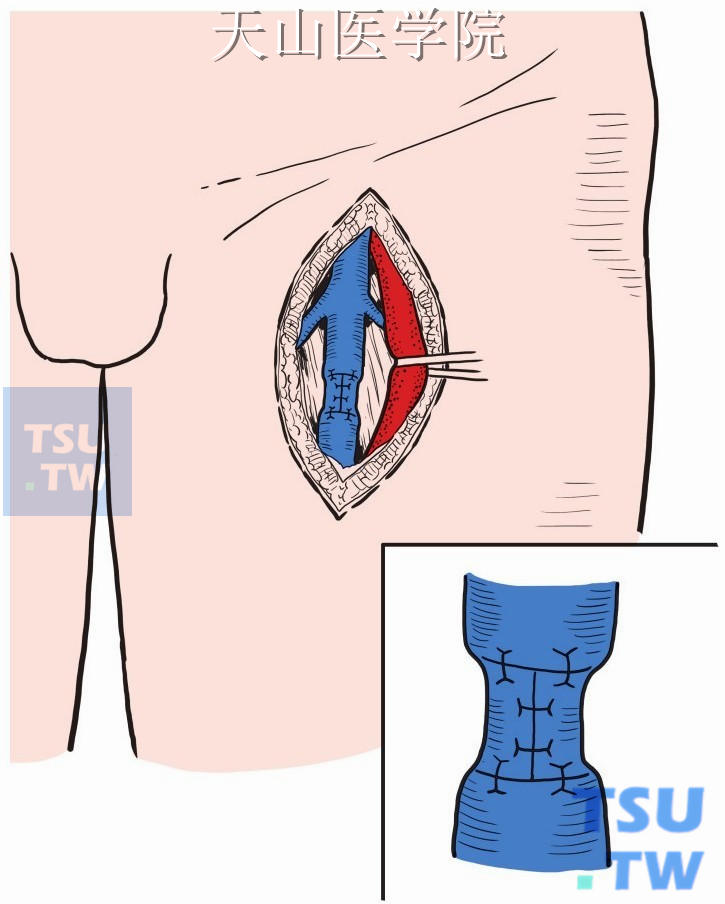 用7-0无损伤缝线将此组织片包绕缝合于股浅静脉最高一对瓣膜的管壁外，以缩小其管径1/3，再将此组织片的上、下缘与管壁间断缝合数针