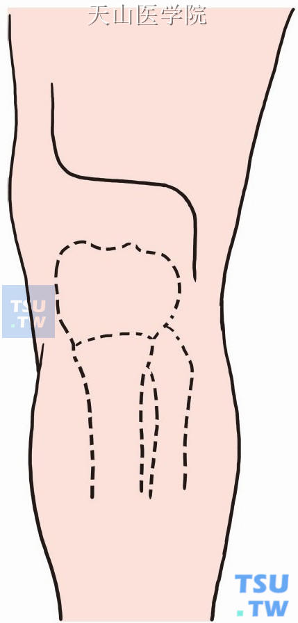 腘窝部做横“S”形切口