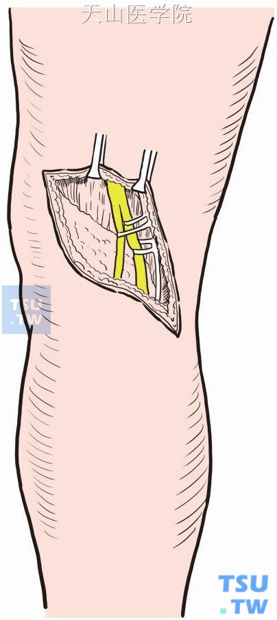 显露并游离胫神经