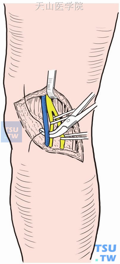 显露腘静脉