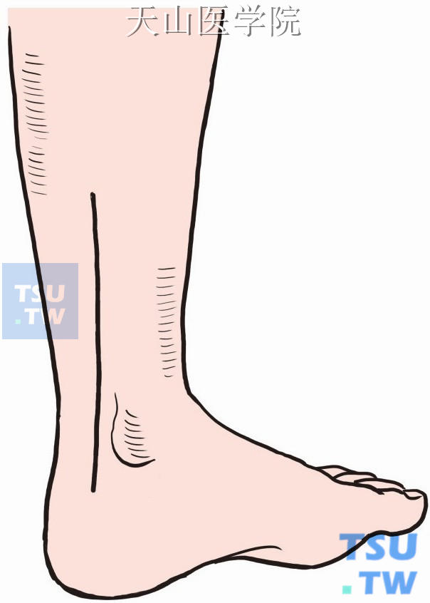 小腿下段胫骨切口，由内踝后方向上延伸