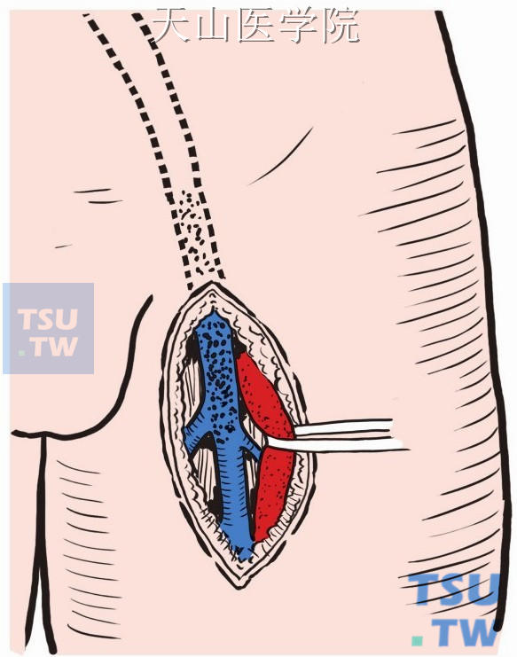 显露股总和股浅动脉近侧段，游离后向一侧牵开