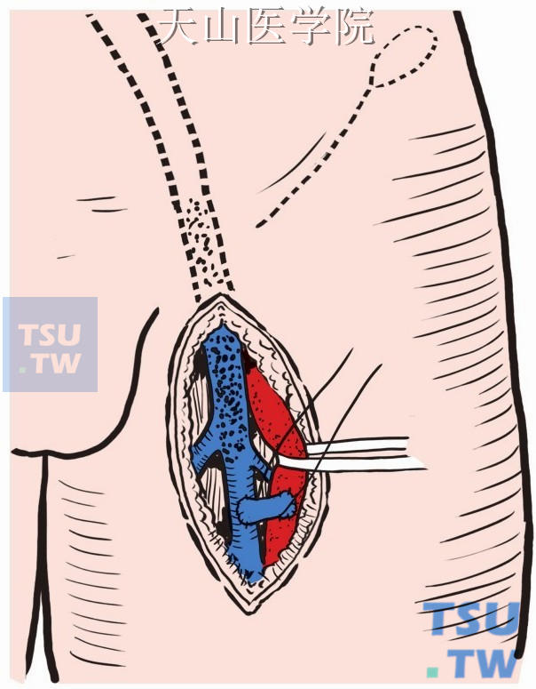 髂—股静脉远侧暂时性动—静脉瘘形成术