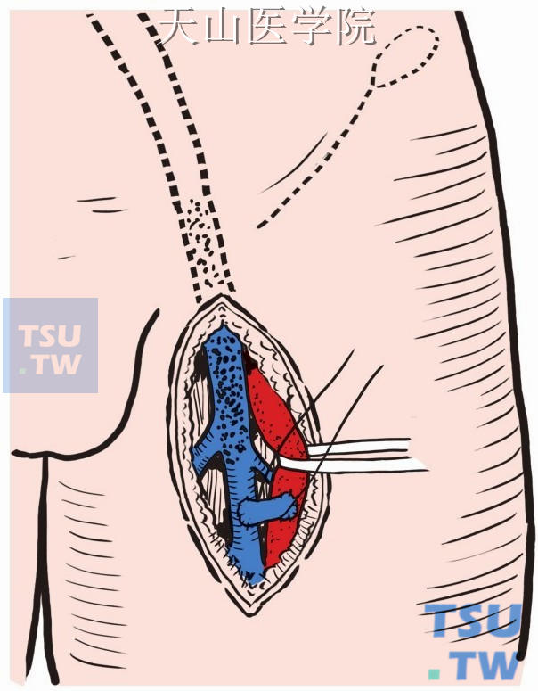 股动、静脉间斜行搭桥形成动—静脉瘘
