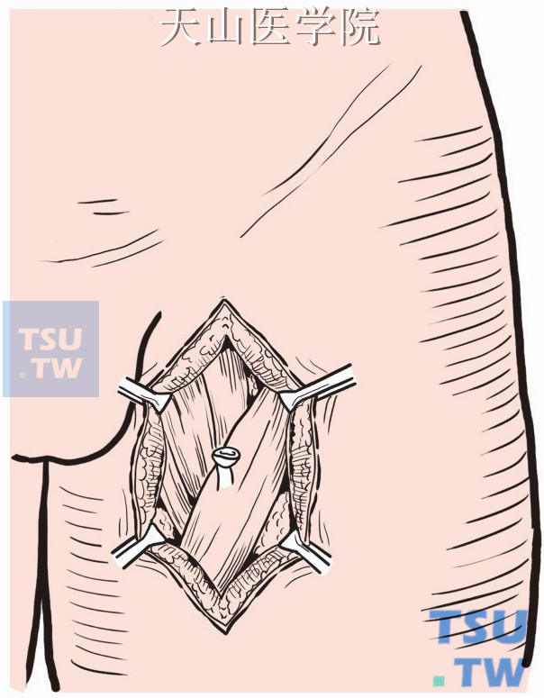 取尼龙线一根，在移植段近动脉侧上宽松地环绕两圈，套入细硅胶管后，留置于皮下