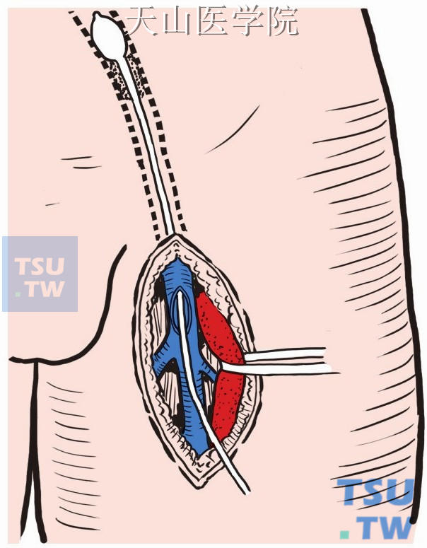 静脉前壁切开，将导管通过该口，近侧插至血栓部位以上