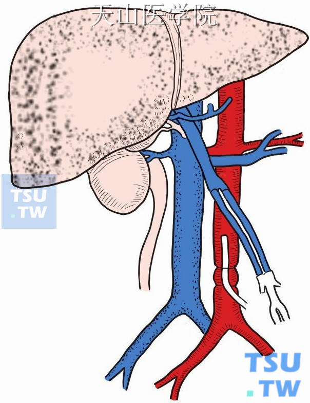 肾动脉以下腹主动脉插管，肠系膜上静脉插管