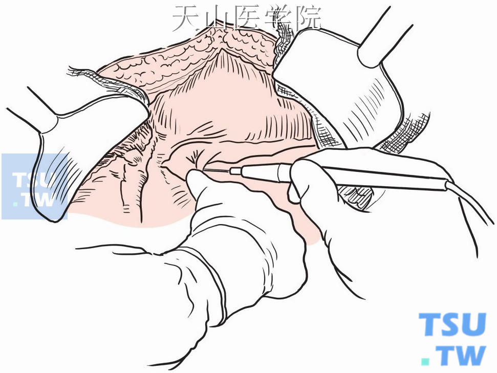 肝周韧带分离