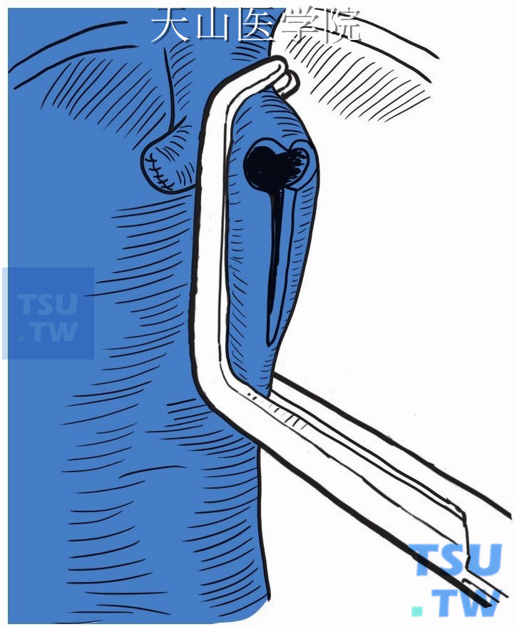 肝静脉连接成共同开口，并向远端延伸