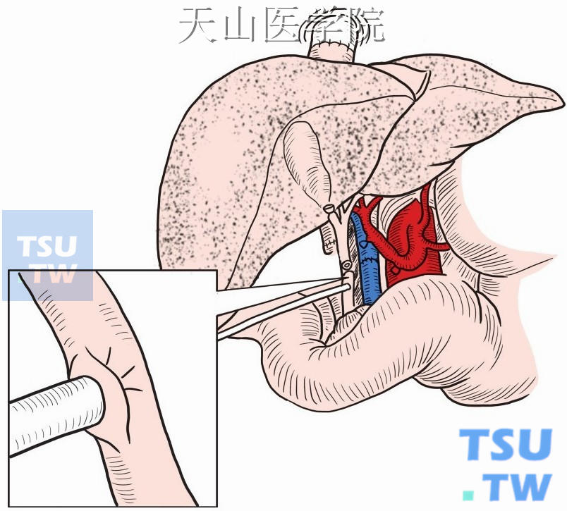 胆管重建