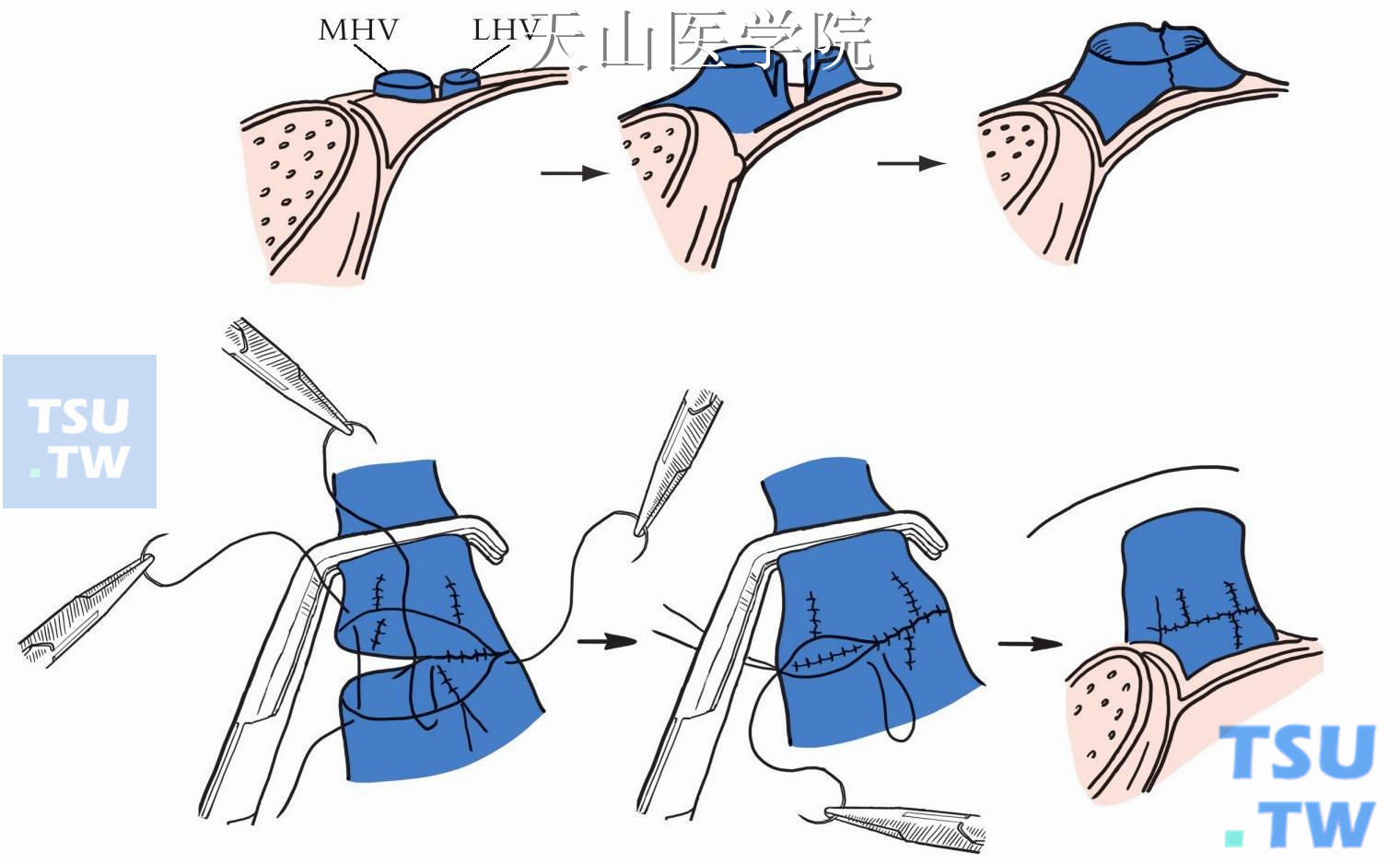 左肝静脉和肝中静脉吻合口成形（LHV：左肝静脉，MHV：肝中静脉）