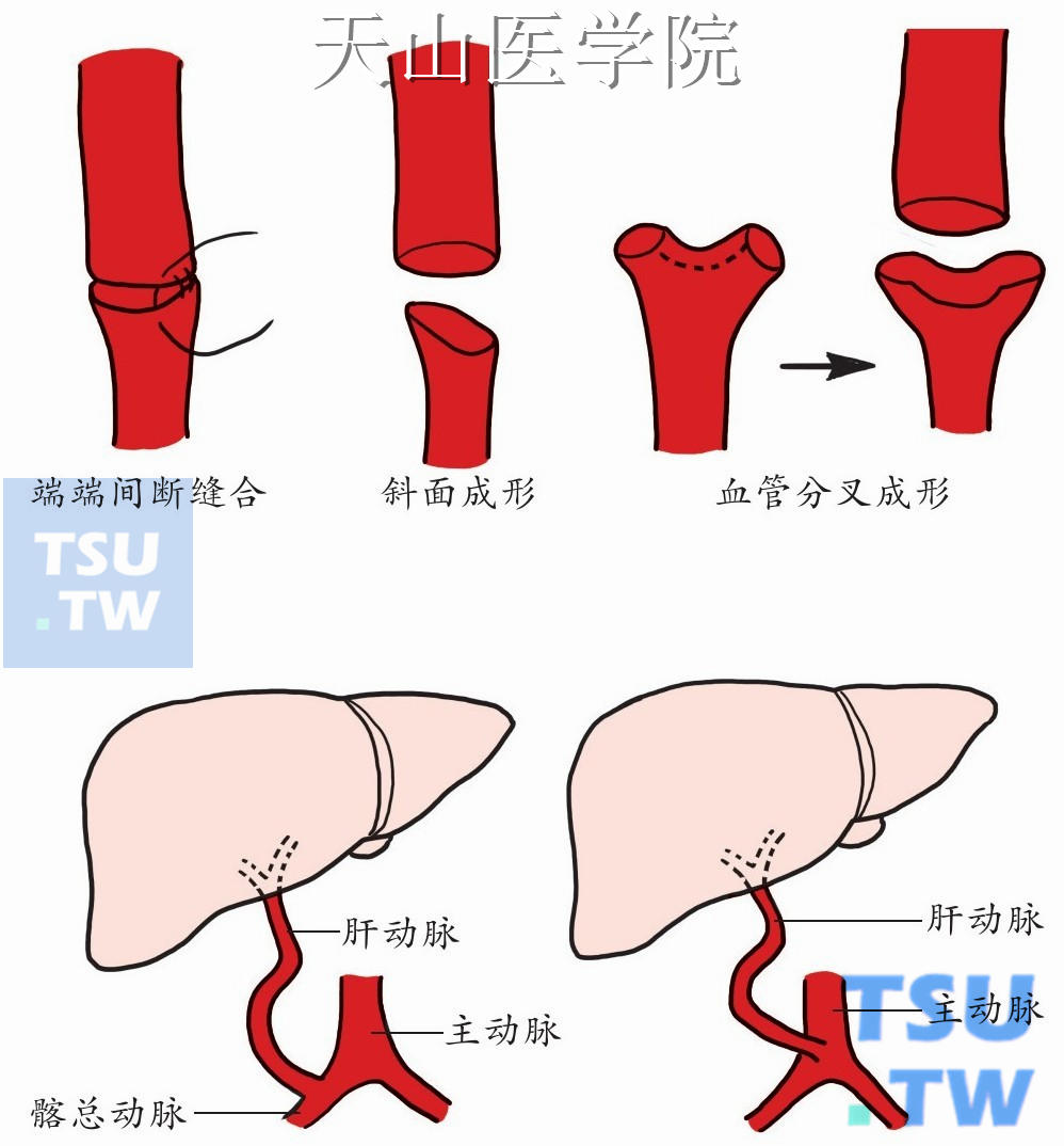 肝动脉重建（包括肝动脉—髂总动脉、肝动脉—主动脉搭桥）