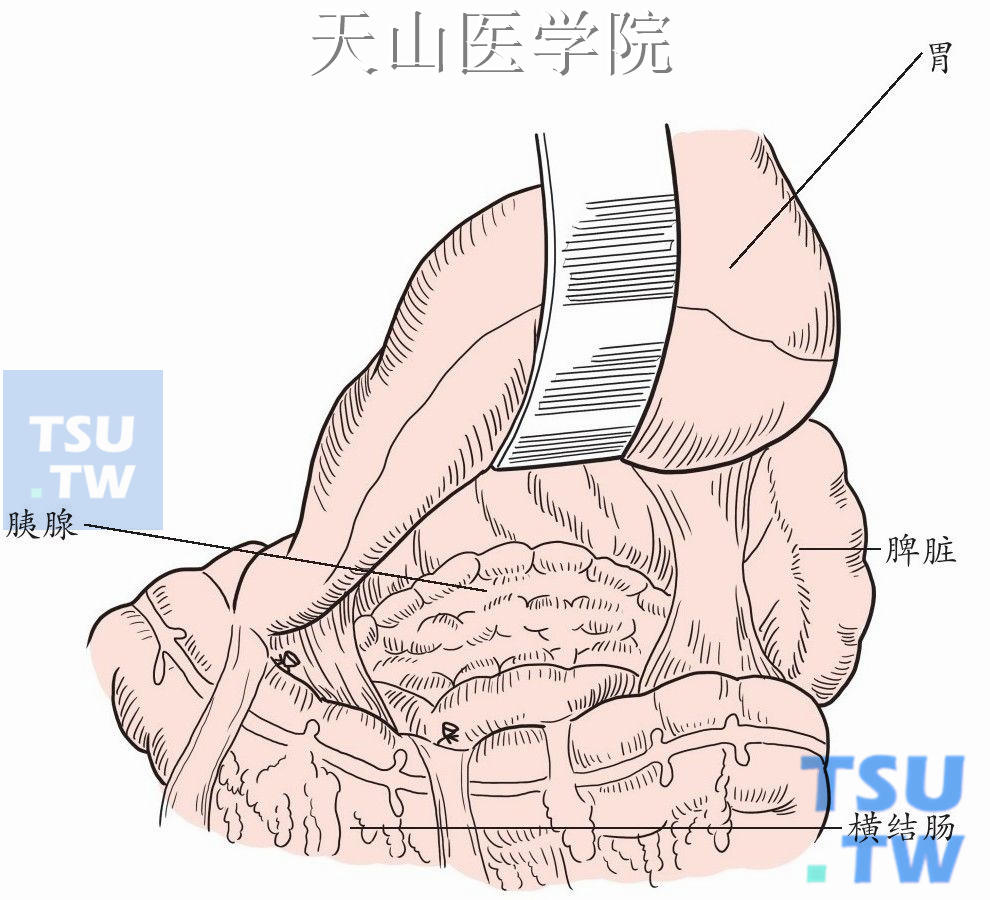 打开胃结肠韧带进入小网膜囊