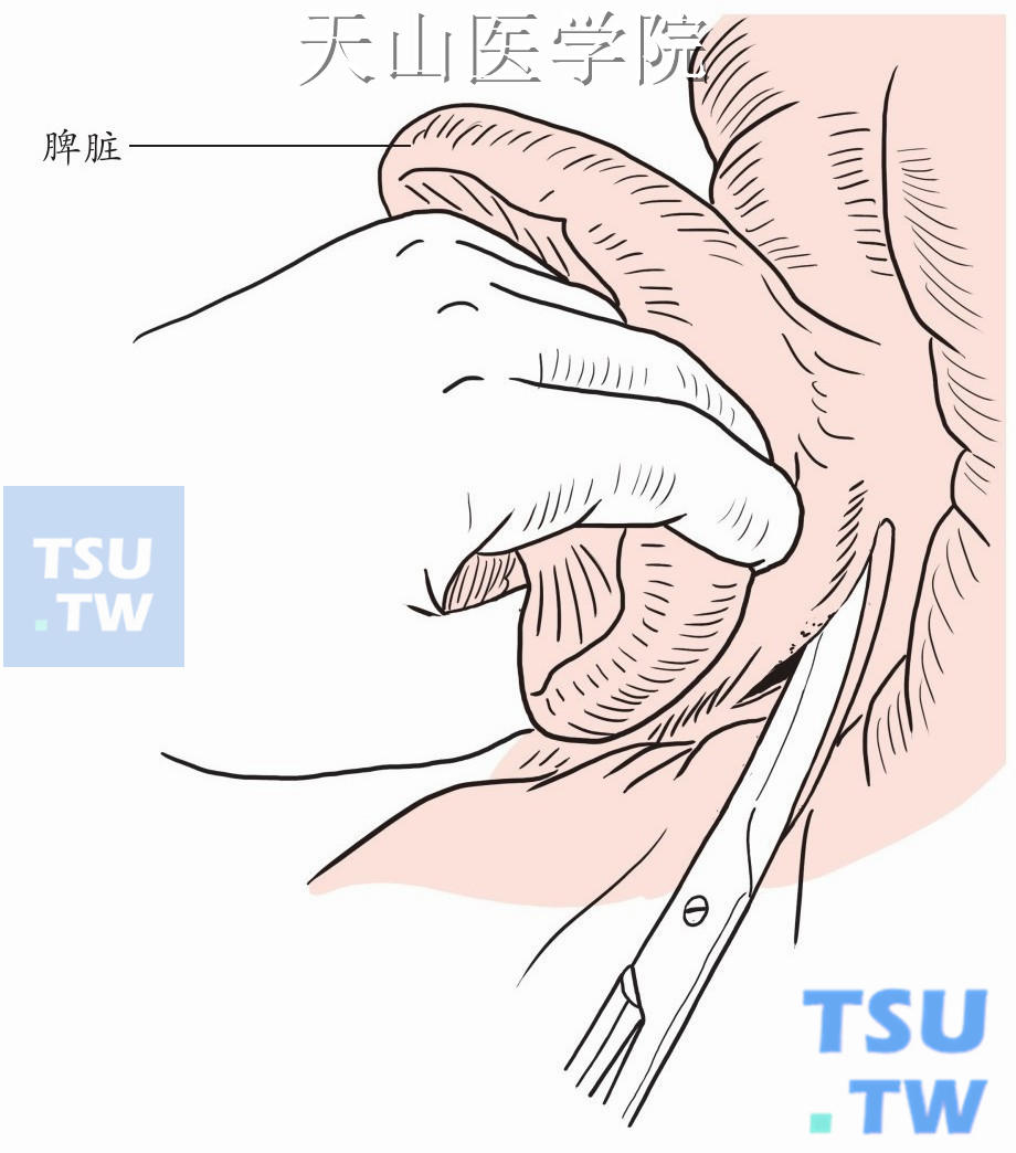 游离脾脏