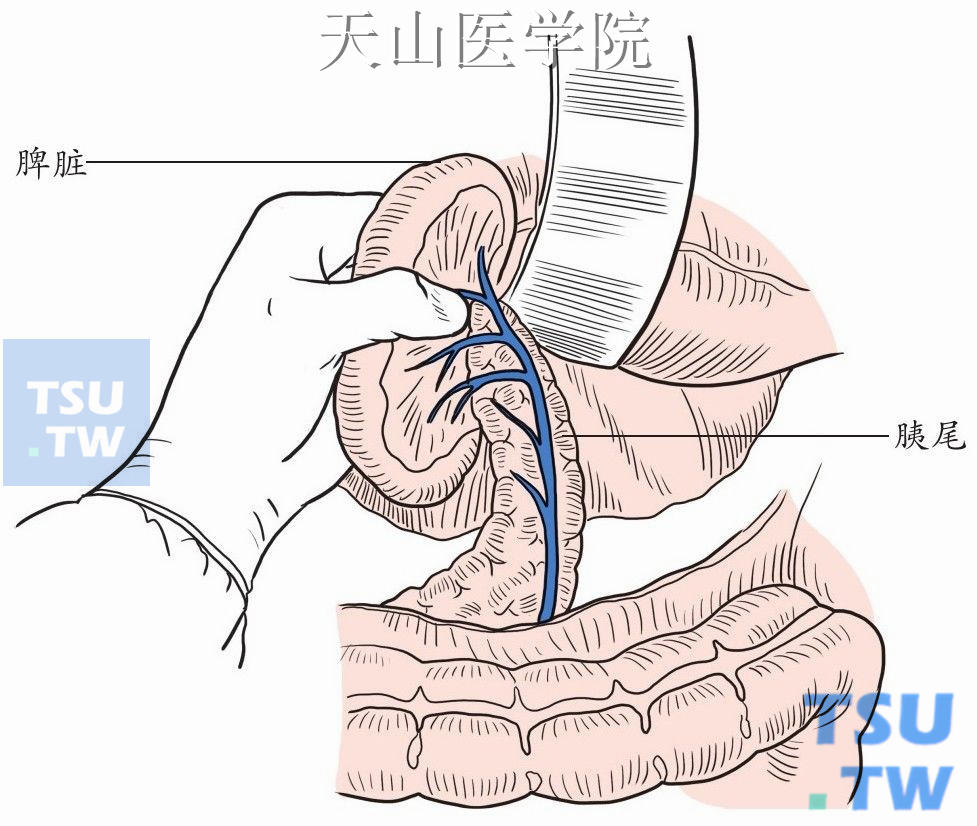 握住脾脏提起胰尾