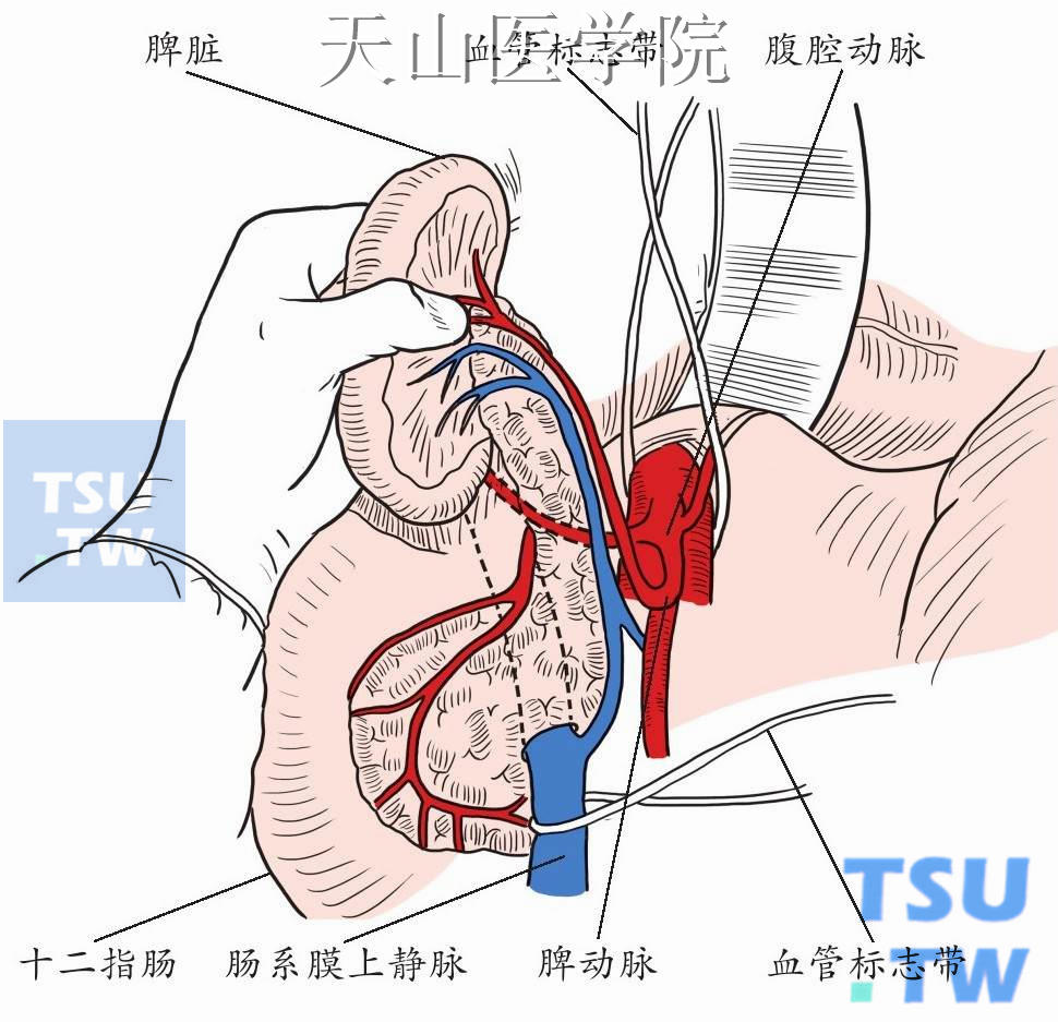 游离肠系膜上静脉