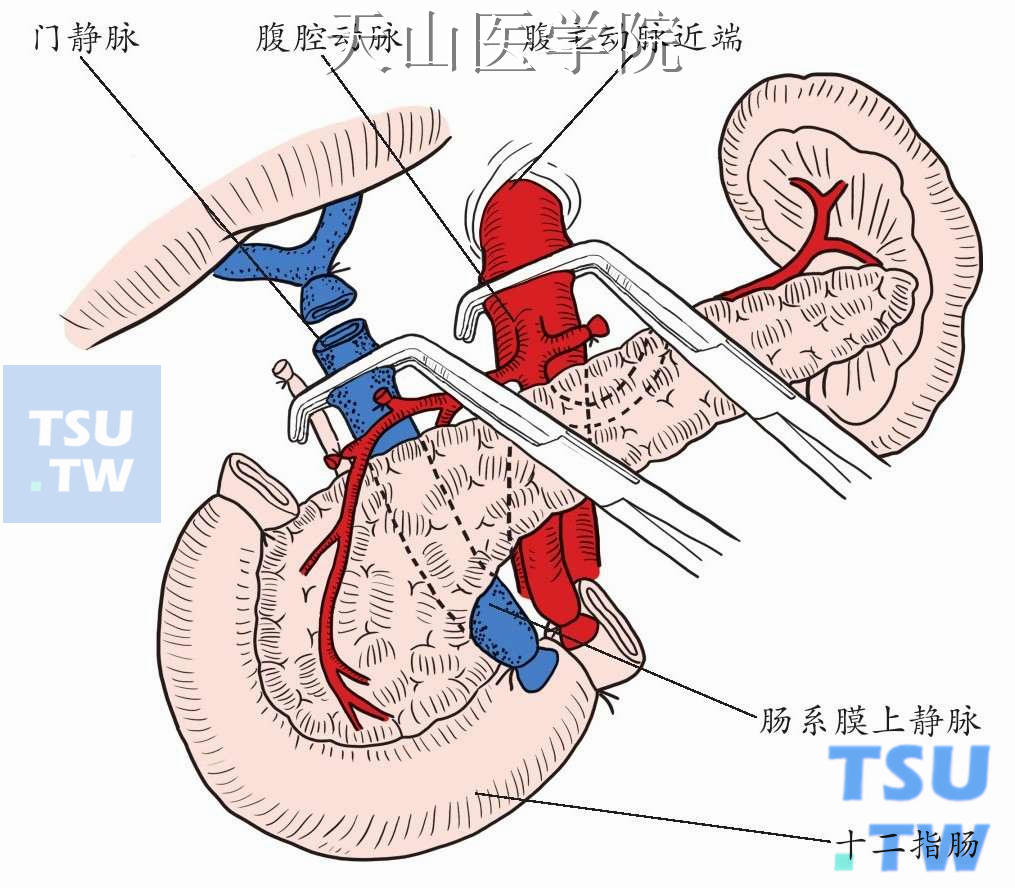 整个胰腺连同十二指肠和脾脏一起切除