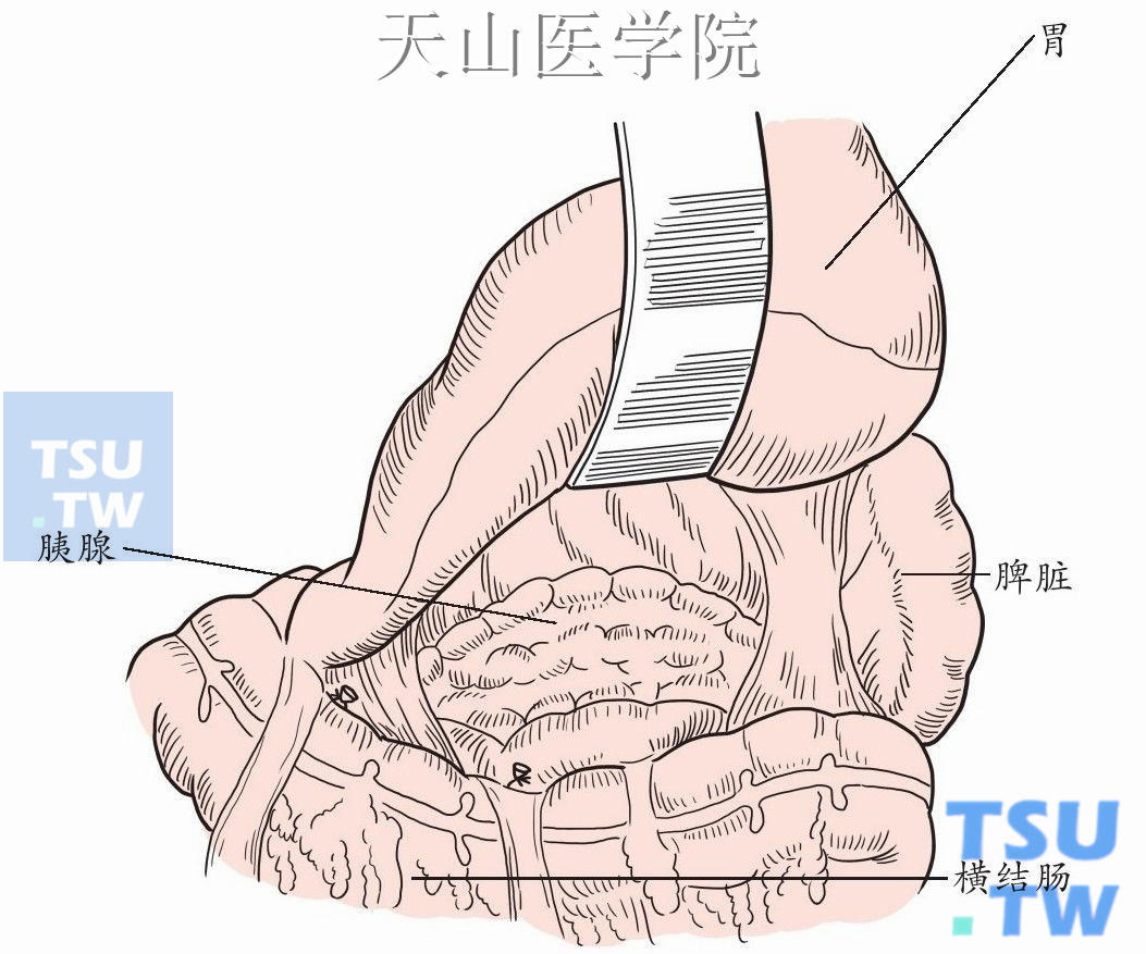 游离胰腺上下缘