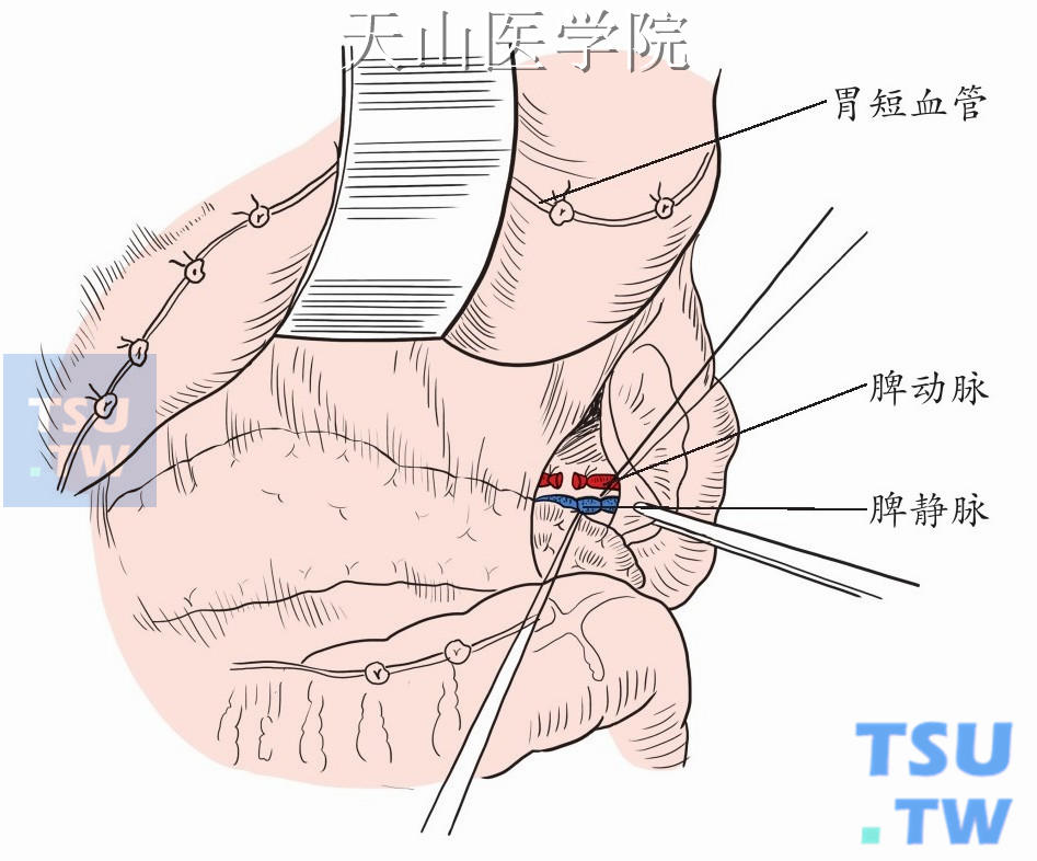 游离胰尾，结扎脾门血管