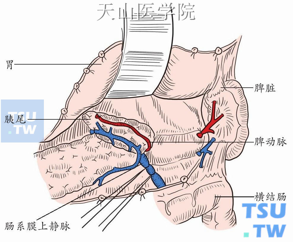 胰腺颈部的游离