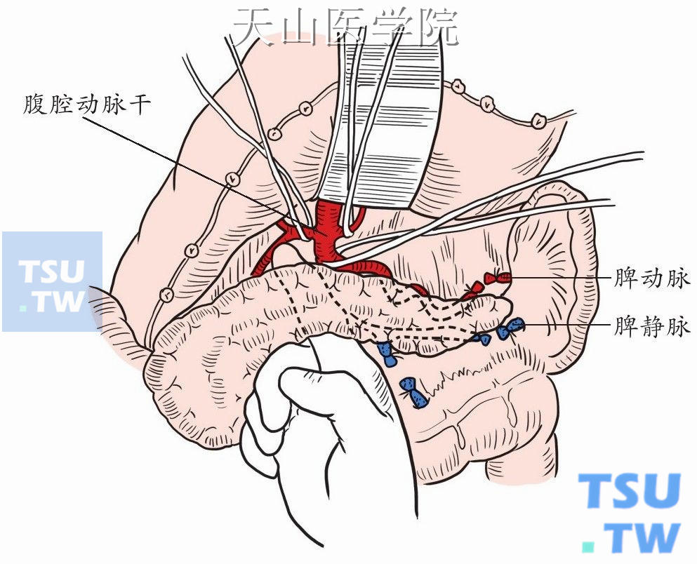 腹腔动脉的游离
