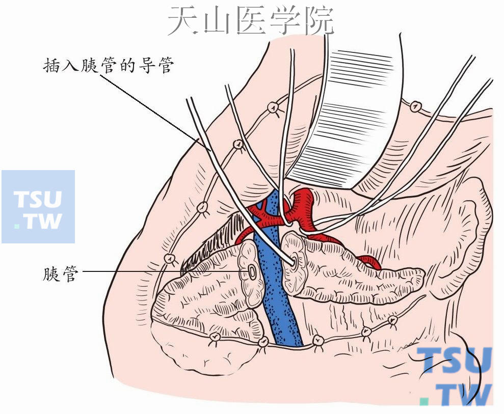 在远端胰腺断面缝扎止血时，小心避免将该段主胰管误扎，所以应事先经主胰管内插入一根硅胶管，而且该管可以作为移植术后移植胰腺胰管支架管引流胰液