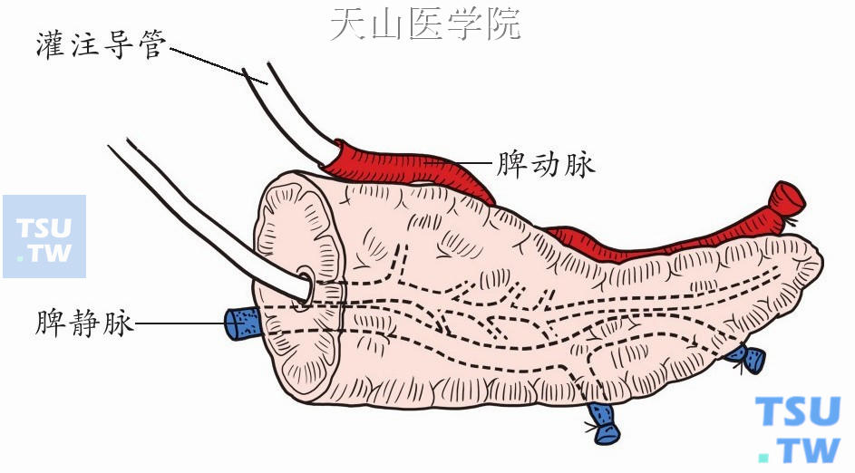 经脾动脉插管灌注胰腺