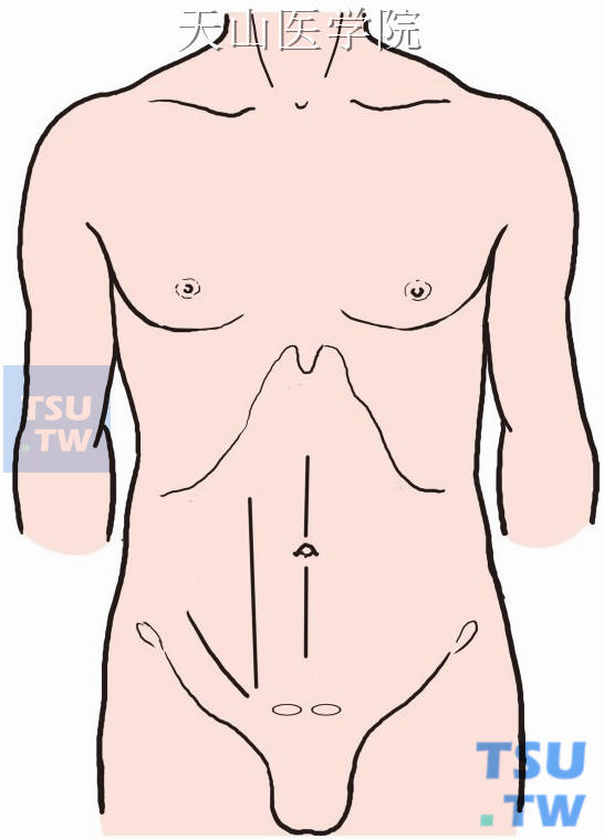 或行腹直肌旁直切口，上自脐水平上2cm，向下至耻骨结节上方进入腹腔