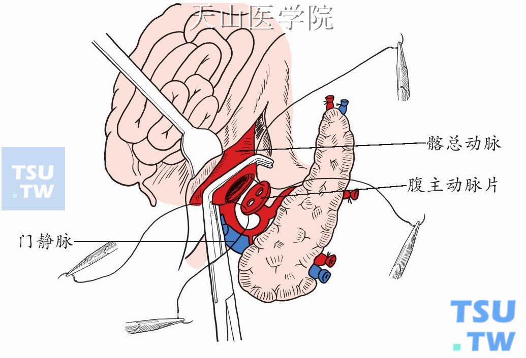 供胰的主动脉片与髂总动脉做端侧吻合
