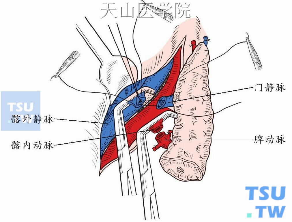 供胰门静脉与受者髂外静脉端侧吻合