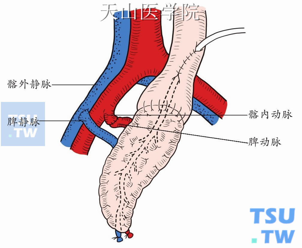 供胰脾静脉与受者髂外静脉端侧吻合；脾动脉与髂内动脉端端吻合