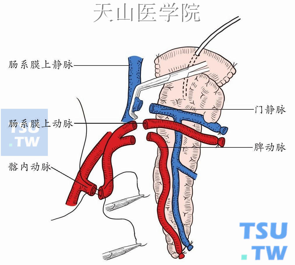 供胰门静脉或脾静脉与肠系膜上静脉端侧吻合，肠系膜上动脉和脾动脉使用间置“Y”形髂血管与髂内动脉吻合