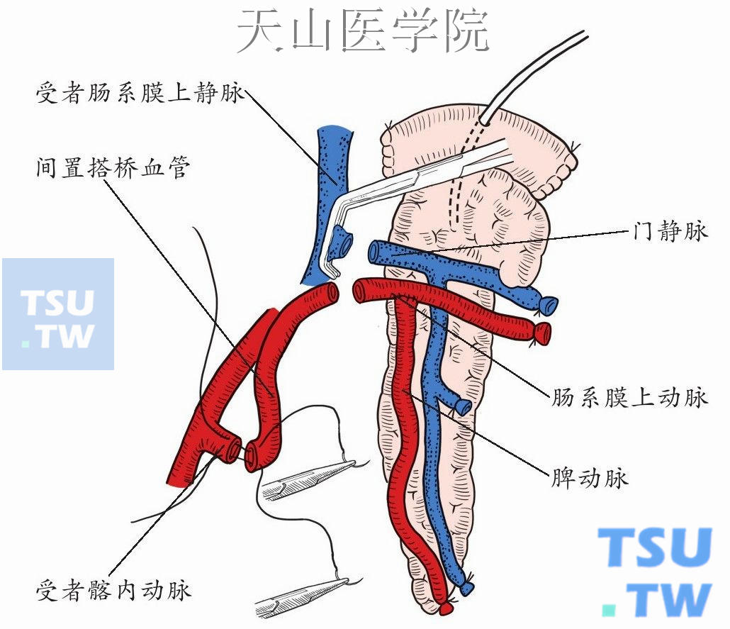 供胰脾动脉先与供胰肠系膜上动脉端侧吻合，用一段供者髂动脉与受者髂内动脉端端吻合，另一端与肠系膜上动脉端端吻合