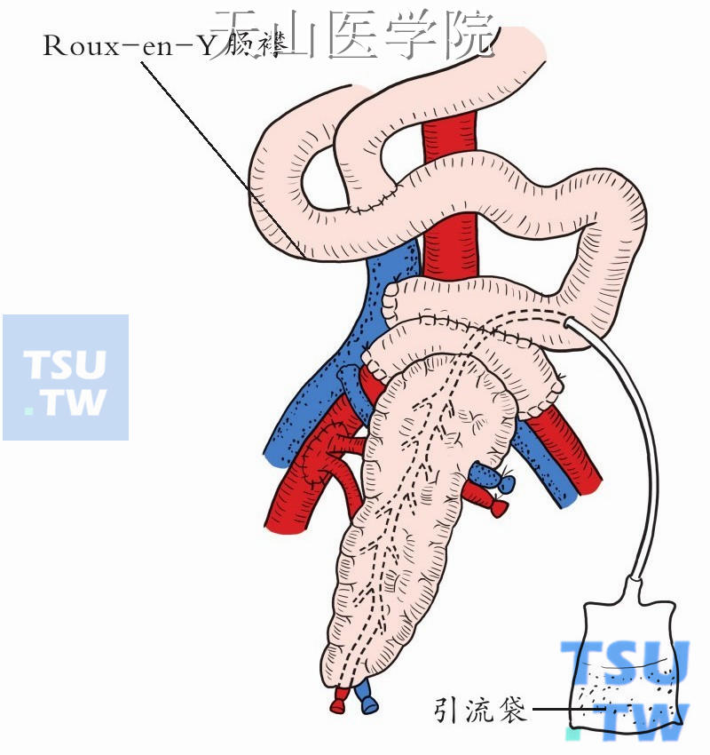 供胰十二指肠与Roux-en-Y空肠襻吻合