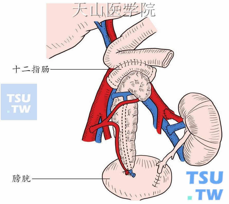 供胰十二指肠与受者空肠吻合