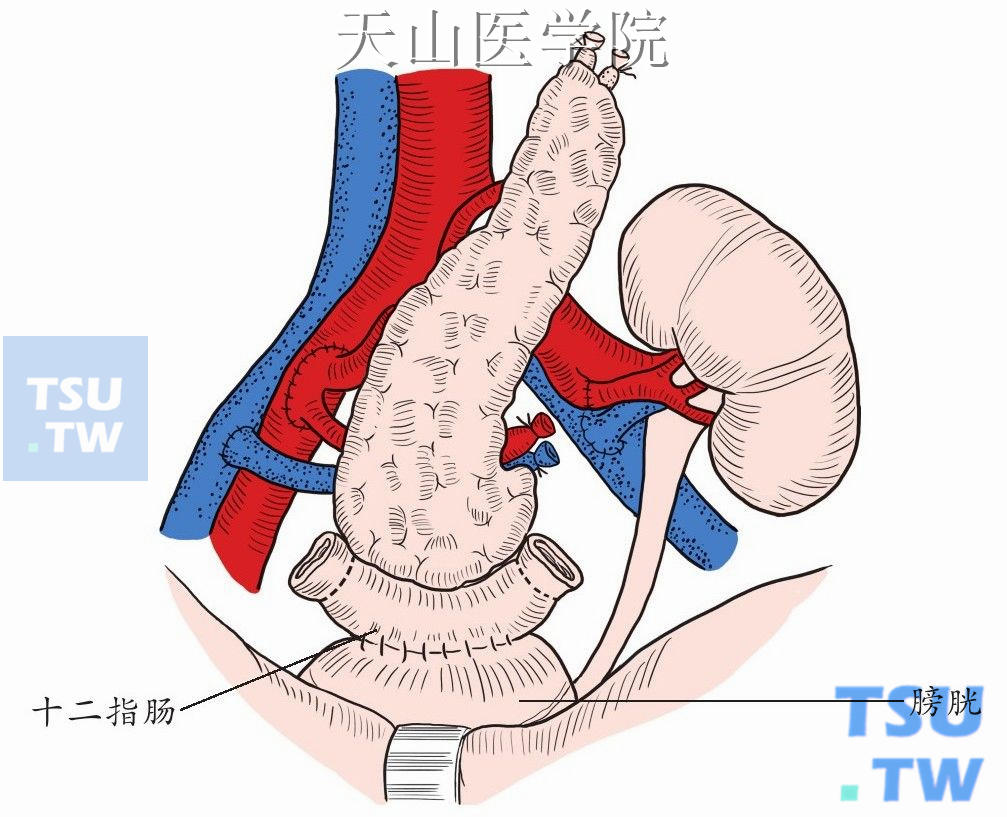 胰肾联合移植膀胱引流式示意图