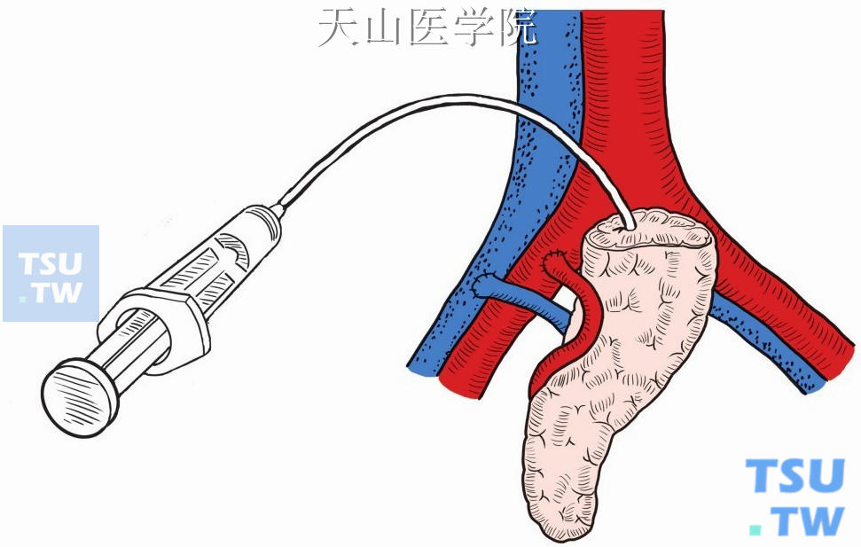 胰管填塞式胰腺移植示意图