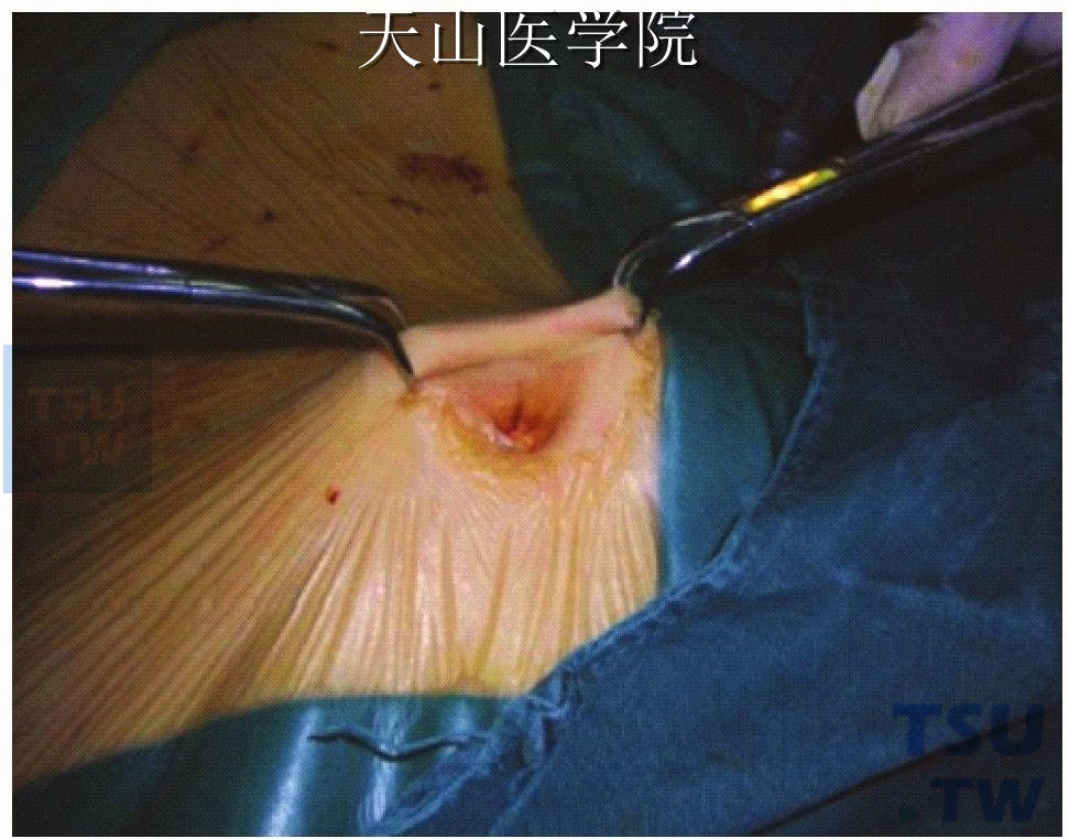 腹腔内手术空间和视野的形成方法