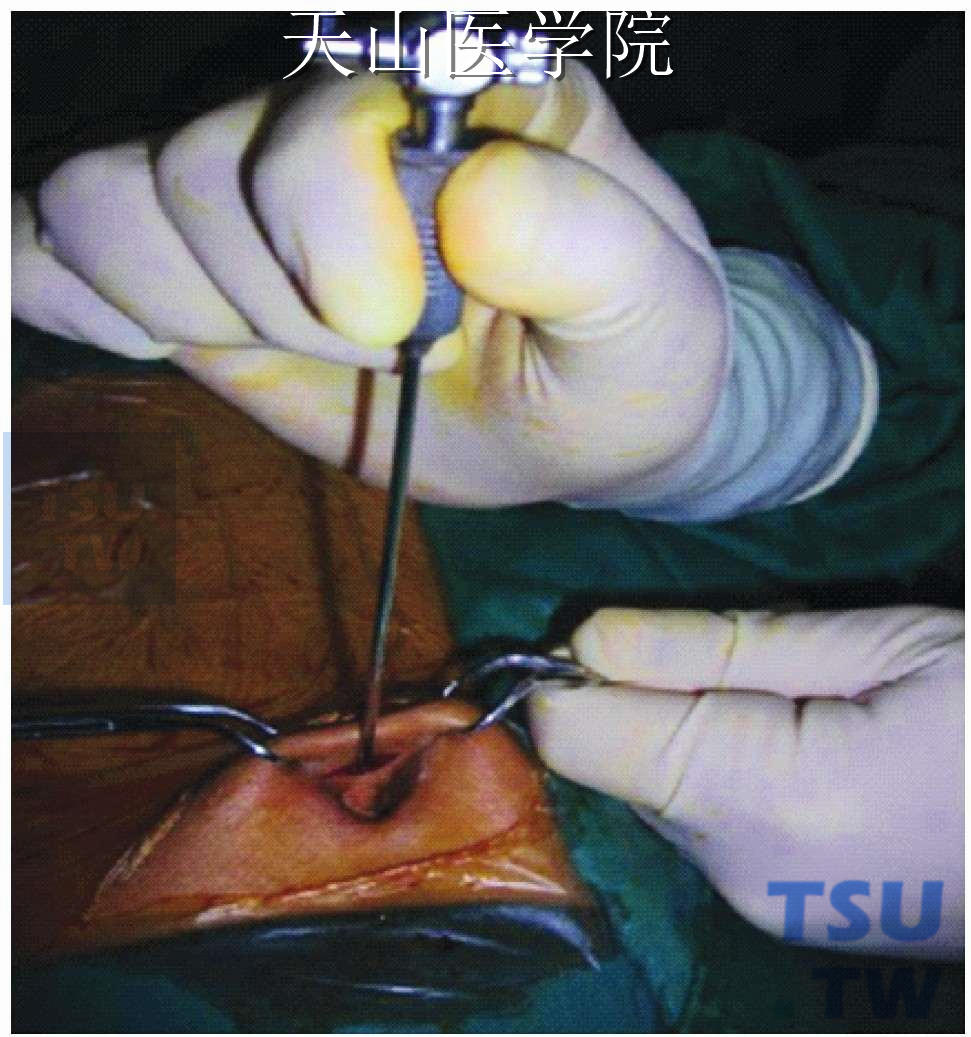 腹腔内手术空间和视野的形成方法 