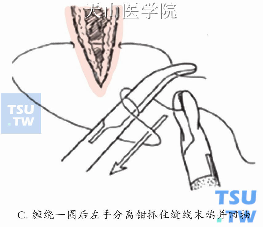 打结流程示意图