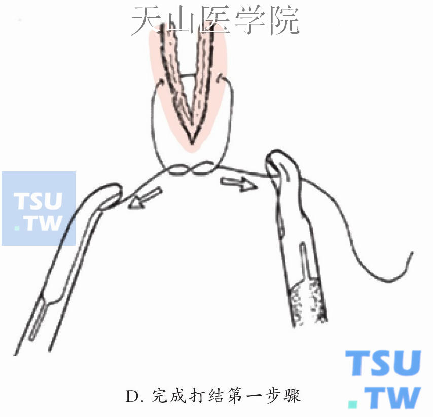 打结流程示意图