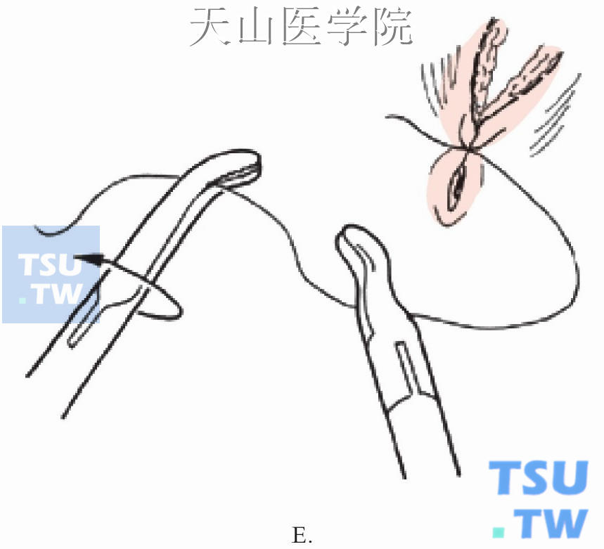 打结流程示意图