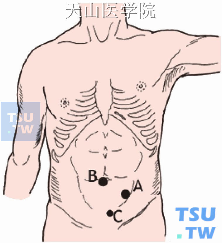 耻骨联合上方偏左2cm处5mm套管为辅助操作孔（C）