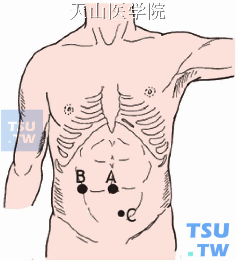 耻骨联合上方偏左2cm处5mm套管为辅助操作孔（C）