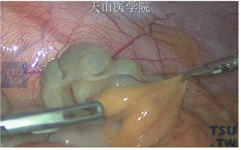 腹腔镜下常规探查腹腔