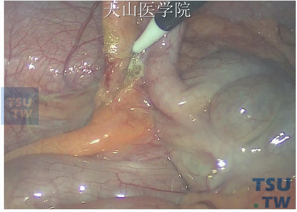 分离阑尾系膜